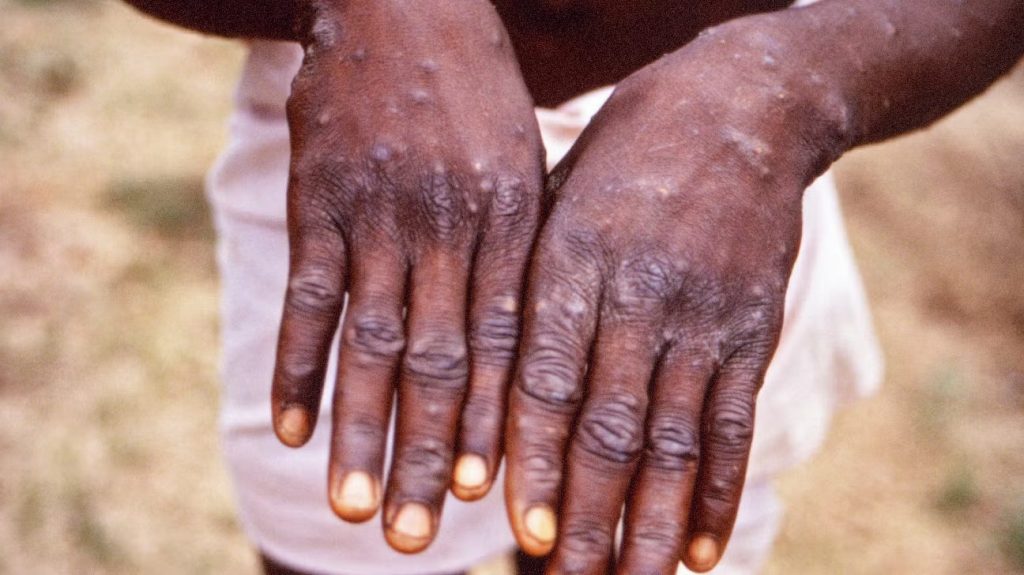 Monkeypox