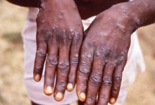 Monkeypox