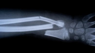 Bone fracture