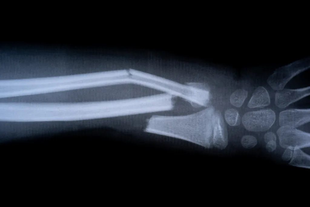 Bone fracture